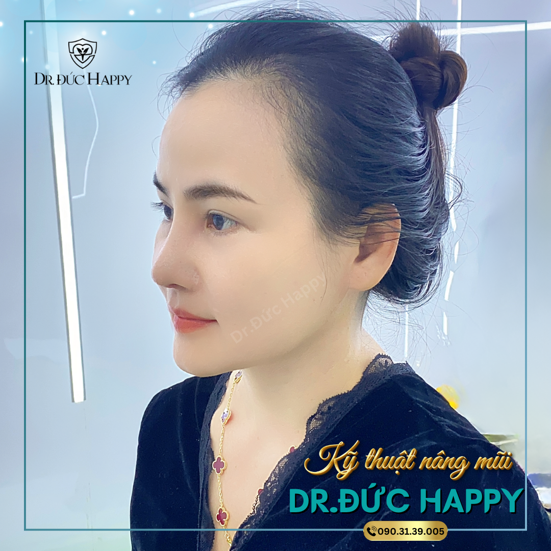 nâng mũi vi phẫu