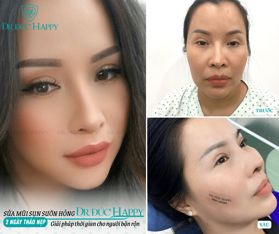 Sửa Mũi Sụn Sườn Hỏng