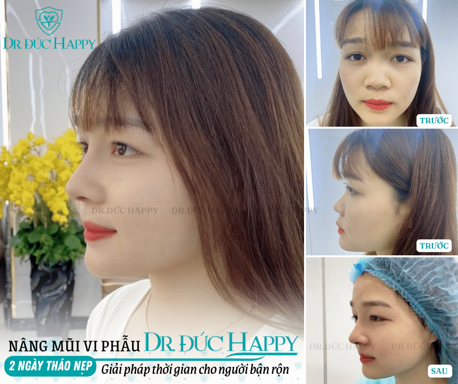 tháo nẹp mũi sớm có tốt không